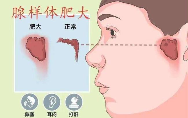 腺樣體肥大能自愈嗎？——深度解析與理解，腺樣體肥大能否自愈？全面深度解析