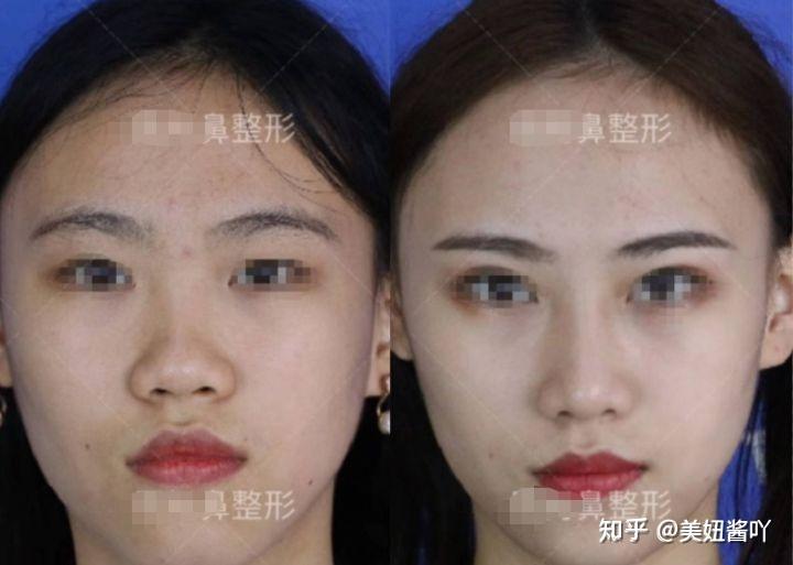 成都隆鼻專家前十名，專業(yè)技藝與信譽并重，成都隆鼻專家前十名，技藝與信譽并重的專業(yè)醫(yī)師
