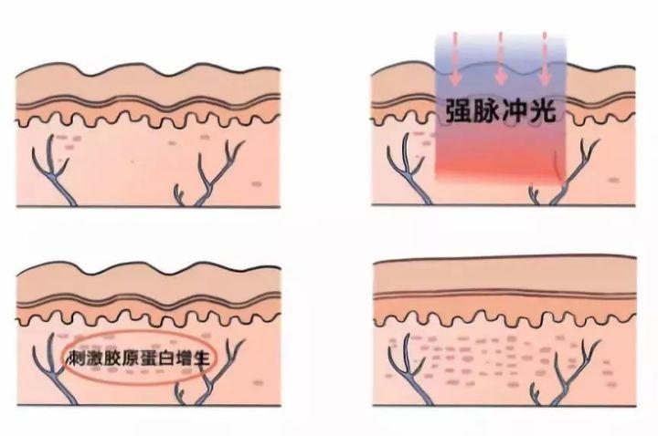 簡(jiǎn)單有效的痘坑修復(fù)方法，讓你的肌膚重拾光彩，簡(jiǎn)單有效的痘坑修復(fù)秘訣，重塑肌膚光彩！