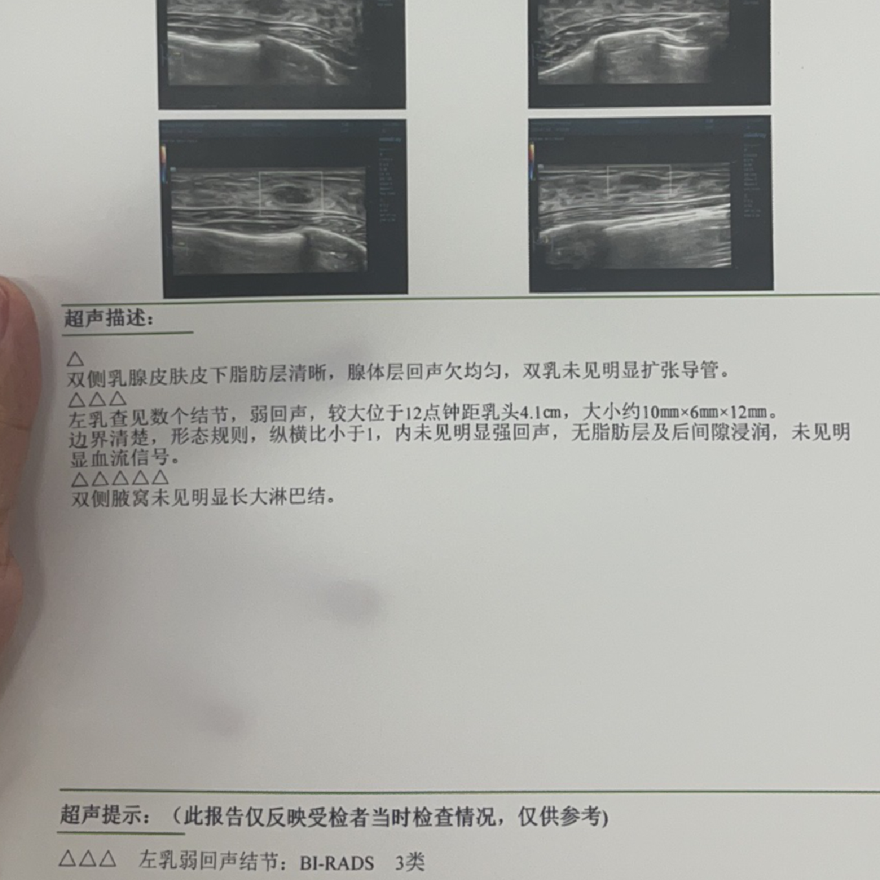 乳腺結(jié)節(jié)3類嚴(yán)重嗎？解讀乳腺健康，讓你了解真相，乳腺結(jié)節(jié)3類嚴(yán)重嗎？解讀乳腺健康真相