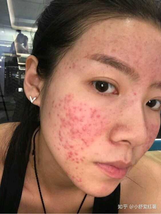 如何有效去除臉上的痘印——全方位指南，全方位指南，如何有效去除臉上痘印的方法