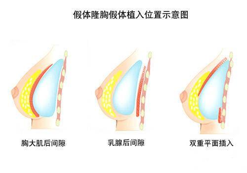 怎么樣才能豐胸最有效最安全，最安全有效的豐胸方法探究
